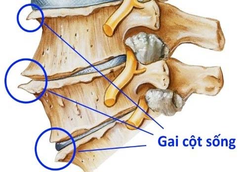 Phương pháp điều trị gai cột sống