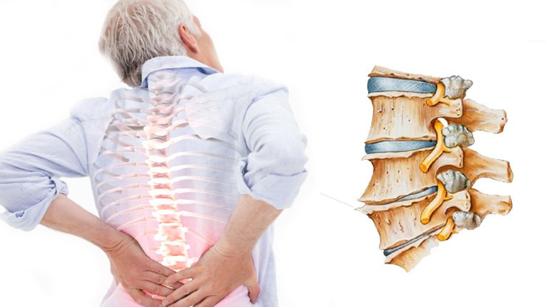 Tổng quan về bệnh Vôi hóa cột sống