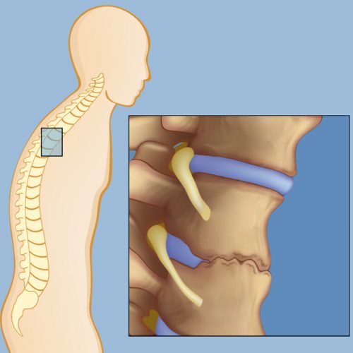 NHẬN BIẾT TRIỆU CHỨNG VÀ TRỊ LIỆU VIÊM CỘT SỐNG HIỆU QUẢ LÂU DÀI