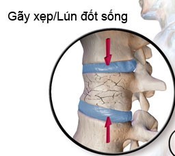 XẸP ĐỐT SỐNG- NGUYÊN NHÂN TRIỆU CHỨNG VÀ HƯỚNG ĐIỀU TRỊ