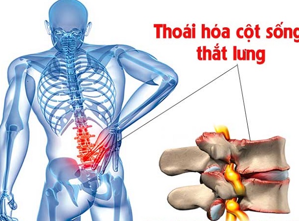 ĐIỀU TRỊ THOÁI HÓA CỘT SỐNG