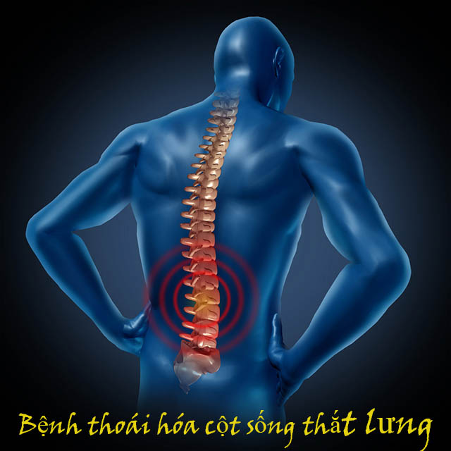Thoái Hóa Cột Sống Lưng – Bệnh Thường Gặp Ở Các Lứa Tuổi, Triệu Chứng, Nguyên Nhân, Phương Pháp Điều Trị Dứt Điểm !!!