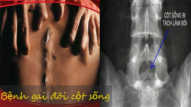 BỆNH BẨM SINH,