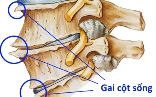 CÁCH ĐIỀU TRỊ BỆNH GAI CỘT SỐNG HIỆU QUẢ