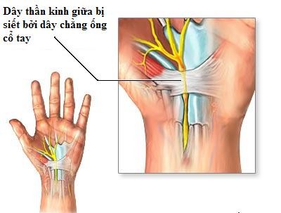 CHẨN ĐOÁN VÀ ĐIỀU TRỊ HỘI CHỨNG ỐNG CỔ TAY