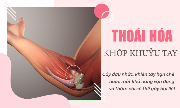 THOÁI HÓA KHỚP KHUỶU TAY LÀ GÌ- PHƯƠNG PHÁP ĐIỀU TRỊ HIỆU QUẢ