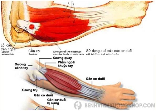 VIÊM KHỚP KHUỶU TAY VÀ LIỆU PHÁP ĐIỀU TRỊ