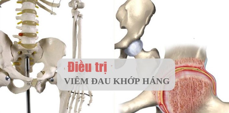 ĐAU KHỚP HÁNG VÀ DẤU HIỆU NHẬN BIẾT