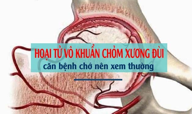 ĐIỀU TRỊ BỆNH HOẠI TỬ CHỎM XƯƠNG ĐÙI “HOẠI TỬ KHỚP HÁNG” KHỎI LÂU DÀI