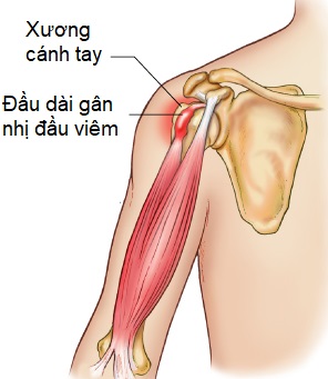 VIÊM GÂN NHỊ ĐẦU VAI : NGUYÊN NHÂN VÀ HƯỚNG ĐIỀU TRỊ