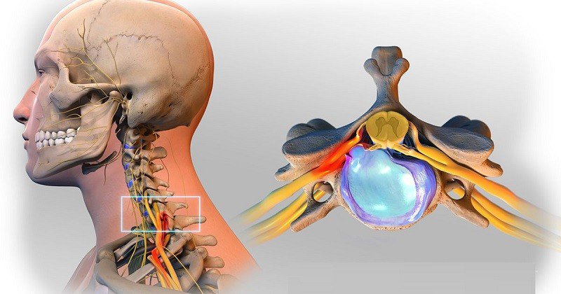 DẤU HIỆU VÀ BIẾN CHỨNG NGUY HIỂM - THOÁT VỊ ĐĨA ĐỆM ĐỐT SỐNG CỔ