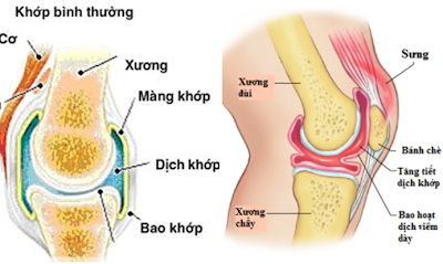 Viêm khớp gối tràn dịch có nguy hiểm không?