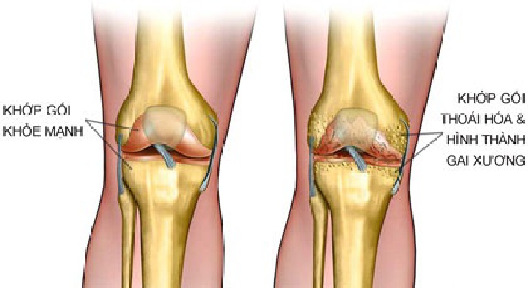 TỔNG QUAN VỀ BỆNH GAI KHỚP GỐI