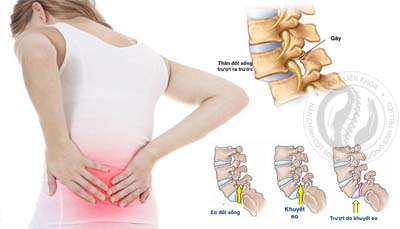 Trượt đốt sống thắt lưng: Cách nhận biết và hướng điều trị hiệu quả