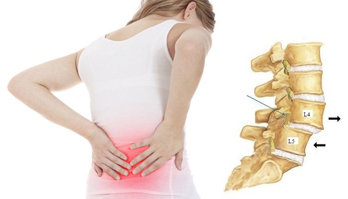CHẾ ĐỘ TẬP LUYỆN VÀ CHẾ ĐỘ ĂN UỐNG CHO NGƯỜI TRƯỢT ĐỐT SỐNG LƯNG