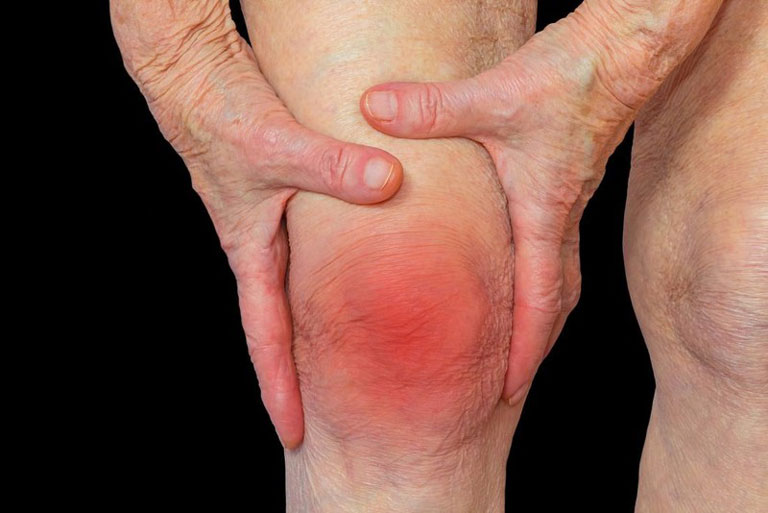 Tiểu Châm Đao kết hợp thuốc Đông Y – Hỗ trợ điều trị Viêm Đa Khớp Dạng Thấp an toàn, hiệu quả lâu dài