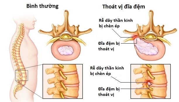 Khi nào cần can thiệp mổ thoát vị đĩa đệm?